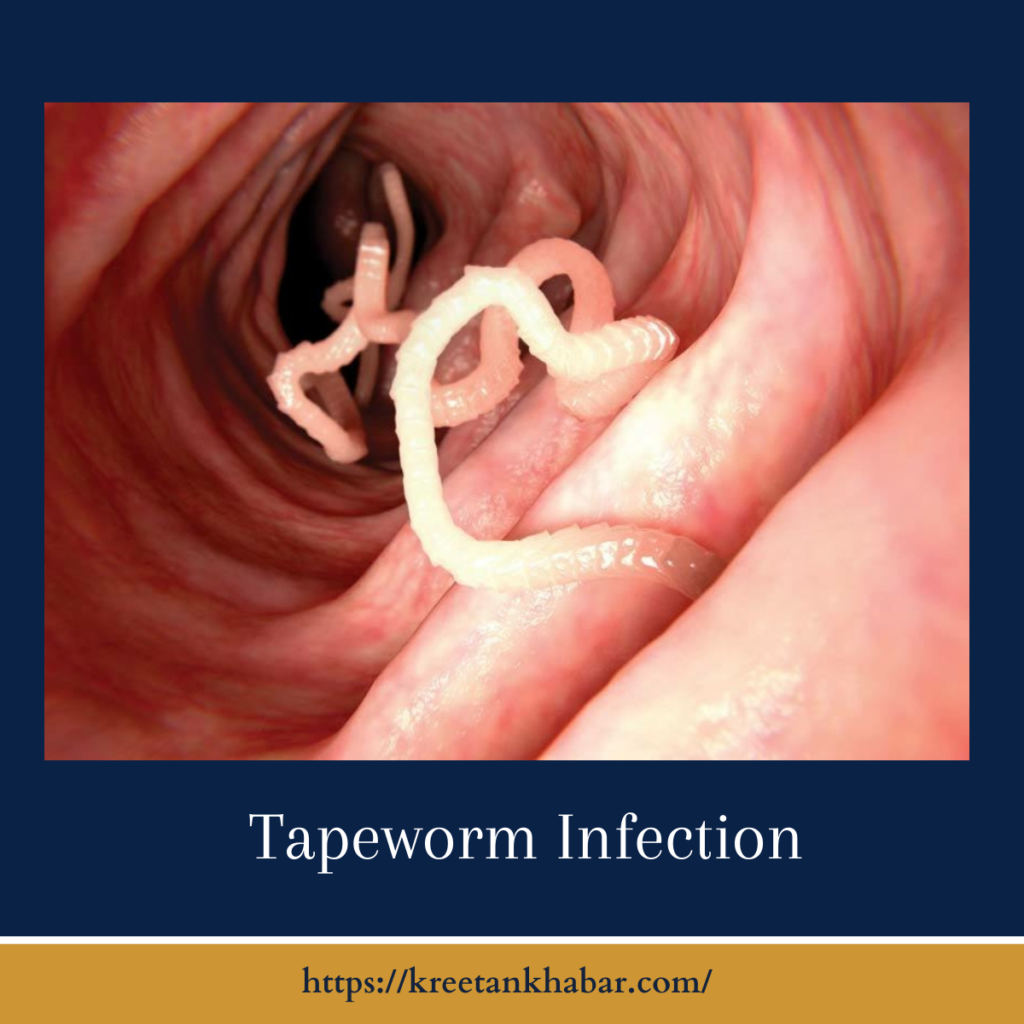 Tapeworm Infection