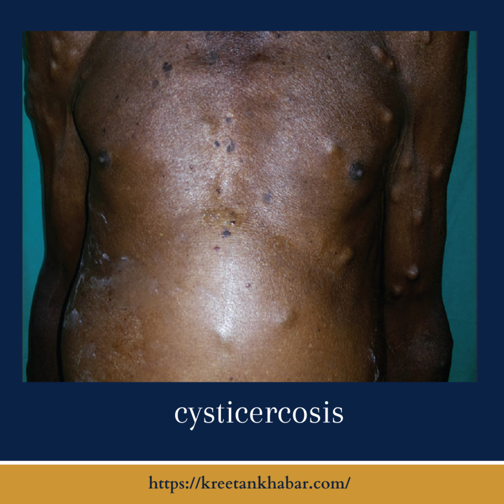 cysticercosis