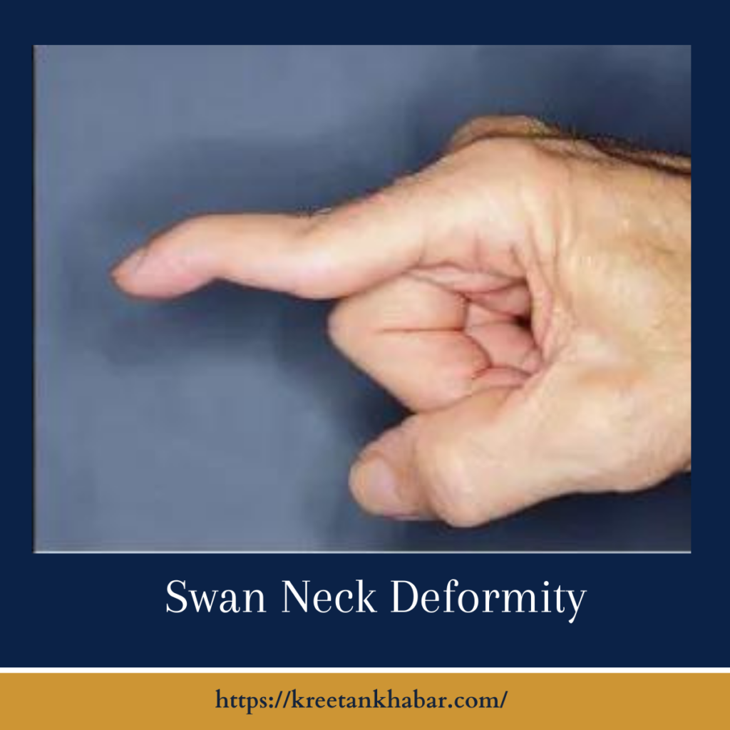 Swan Neck Deformity