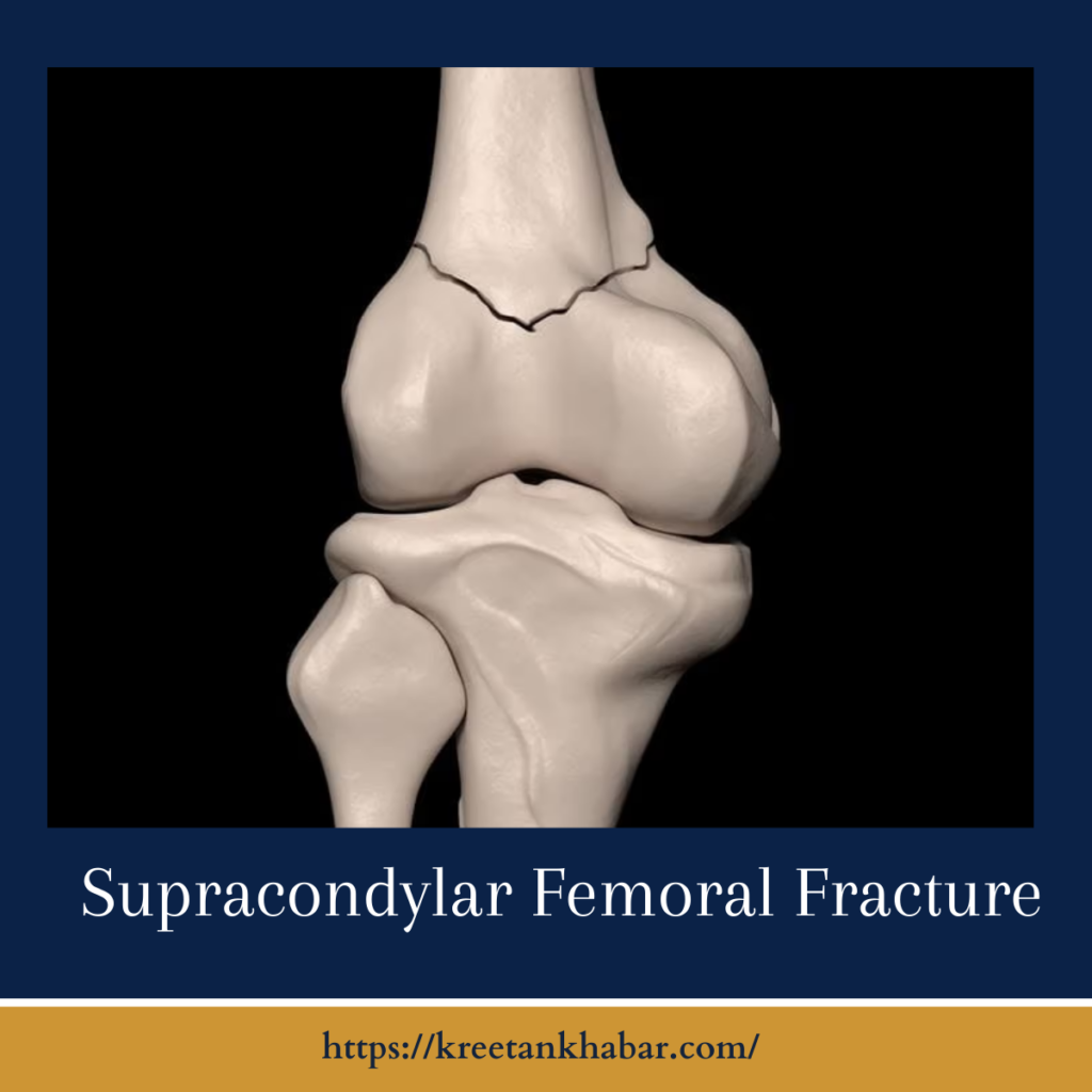 Supracondylar Femoral Fractures