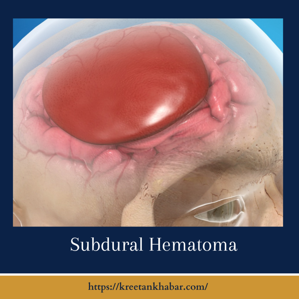 Subdural Hematoma