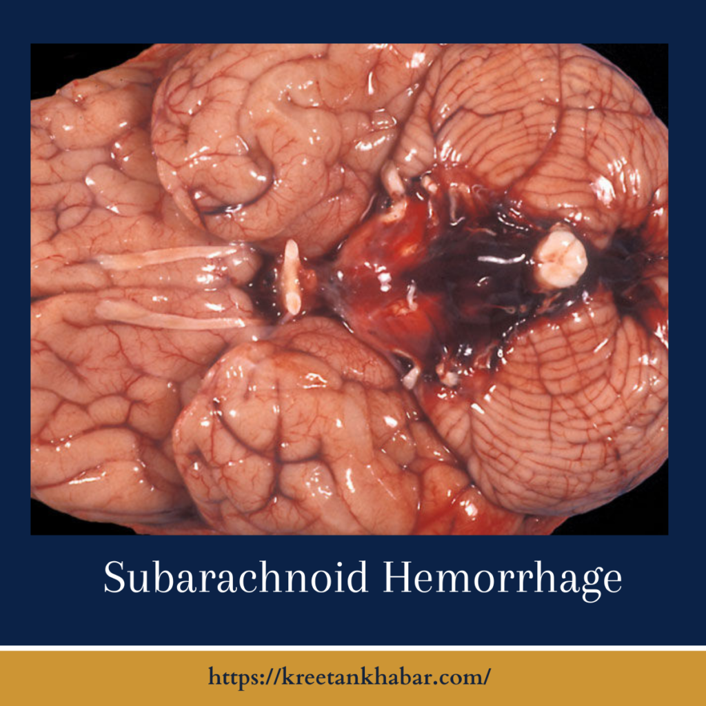 Subarachnoid Hemorrhage