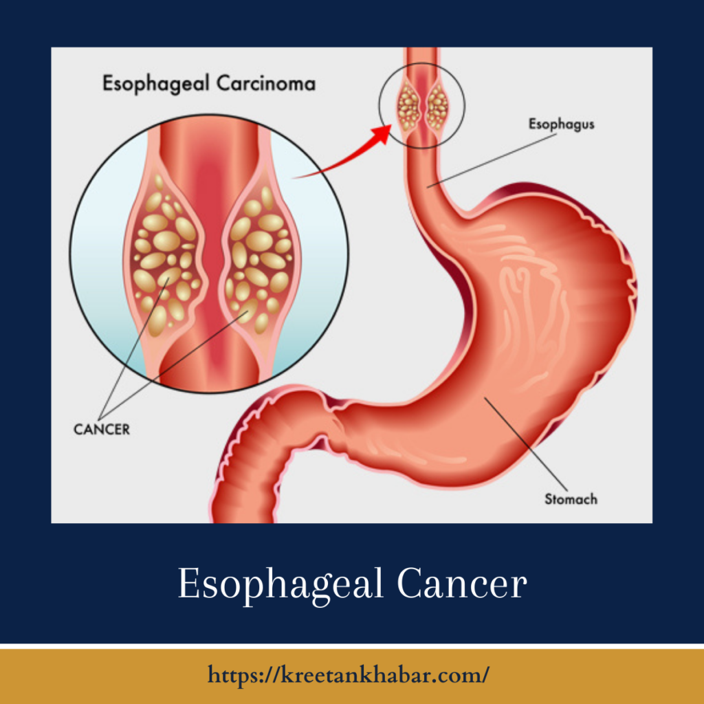 Esophageal Cancer