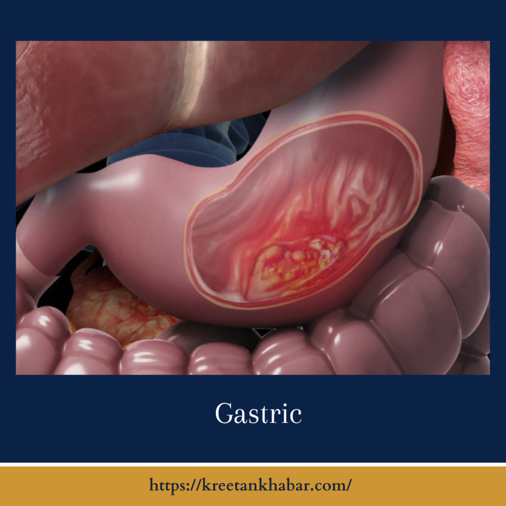 Gastric