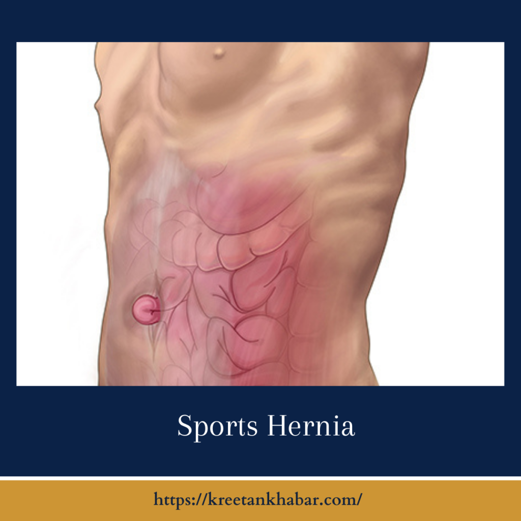 Sports Hernia