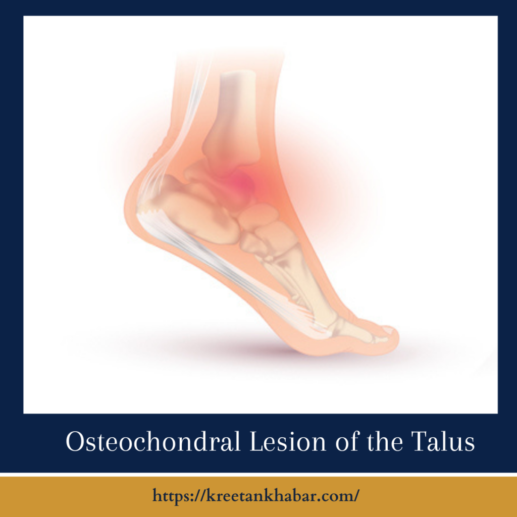 Osteochondral Lesion of the Talus