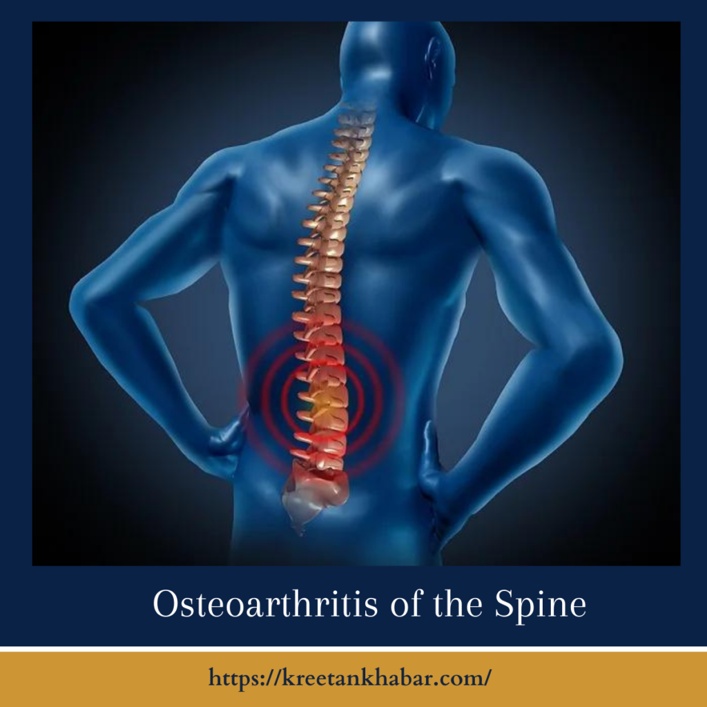 Osteoarthritis of the Spine