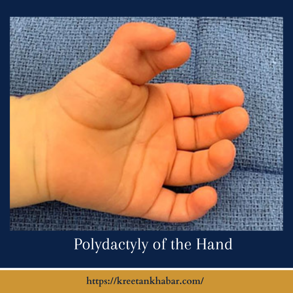 Polydactyly of the Hand