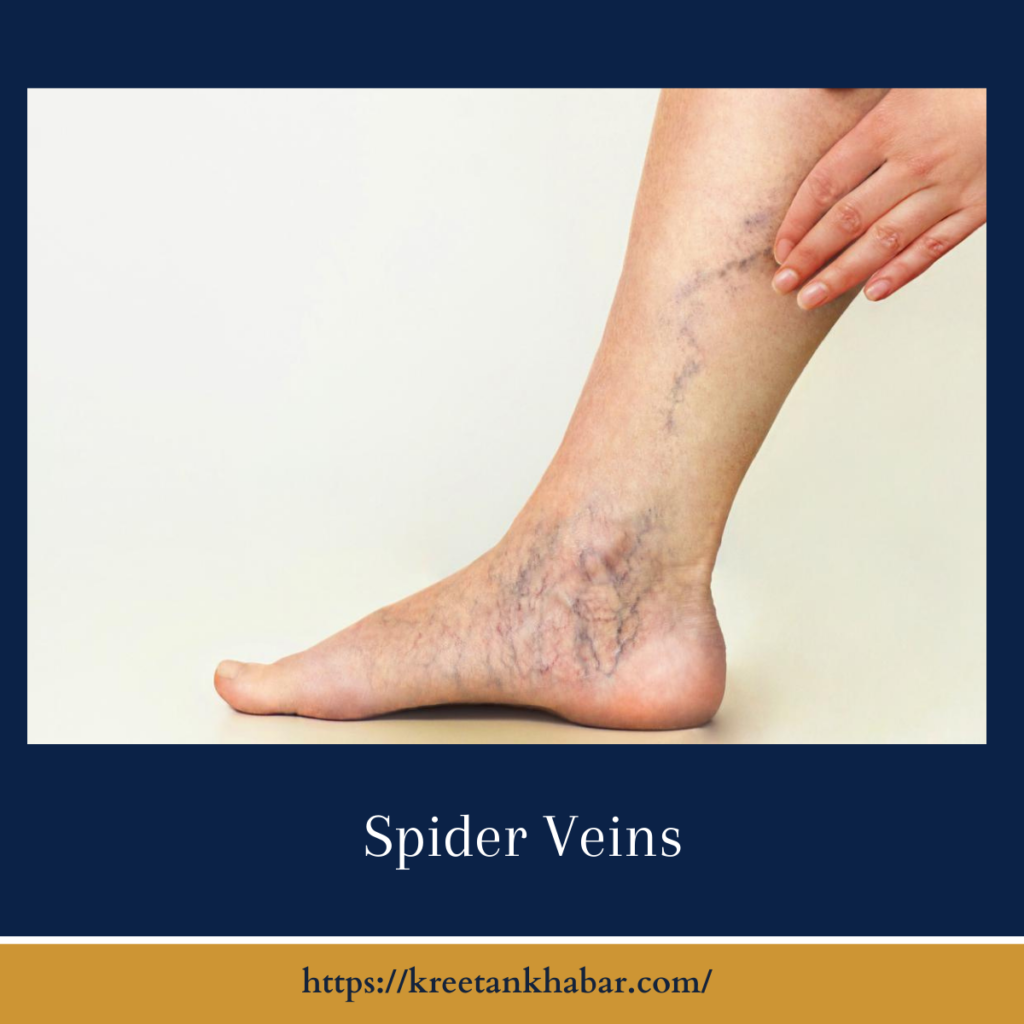 Spider Veins