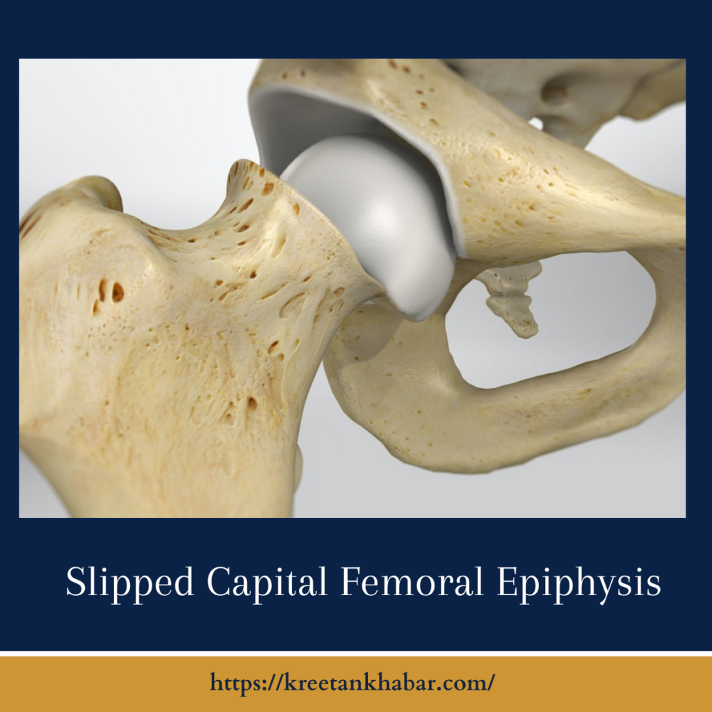 Slipped Capital Femoral Epiphysis