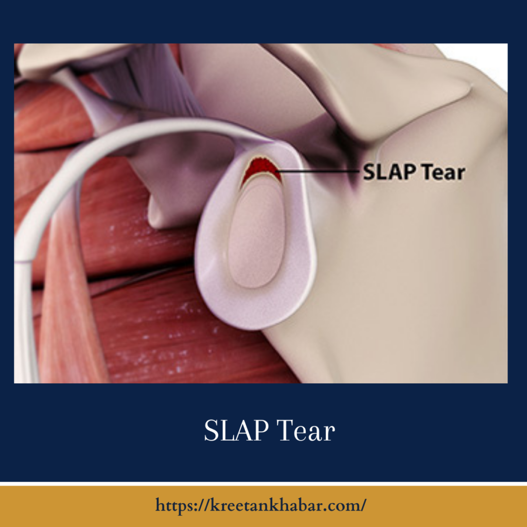 SLAP Tears