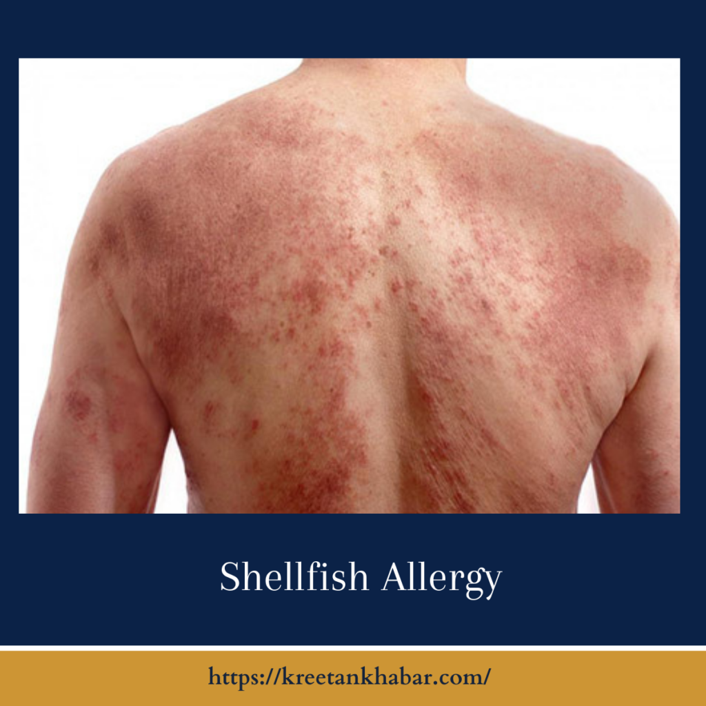 Shellfish Allergy