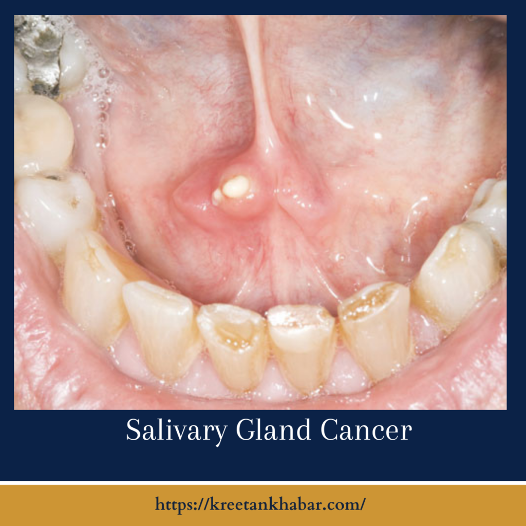 Salivary Gland Cancer