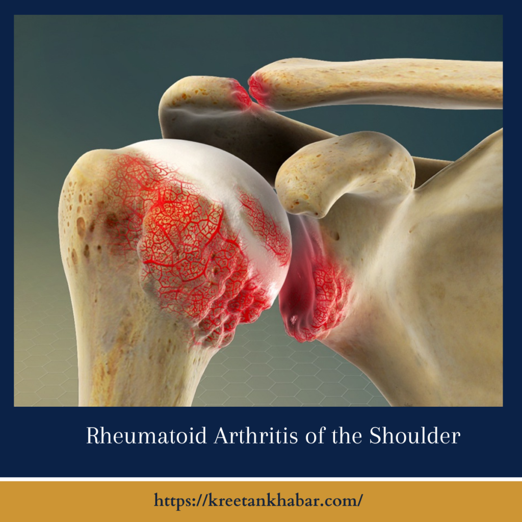 Rheumatoid Arthritis of the Shoulder