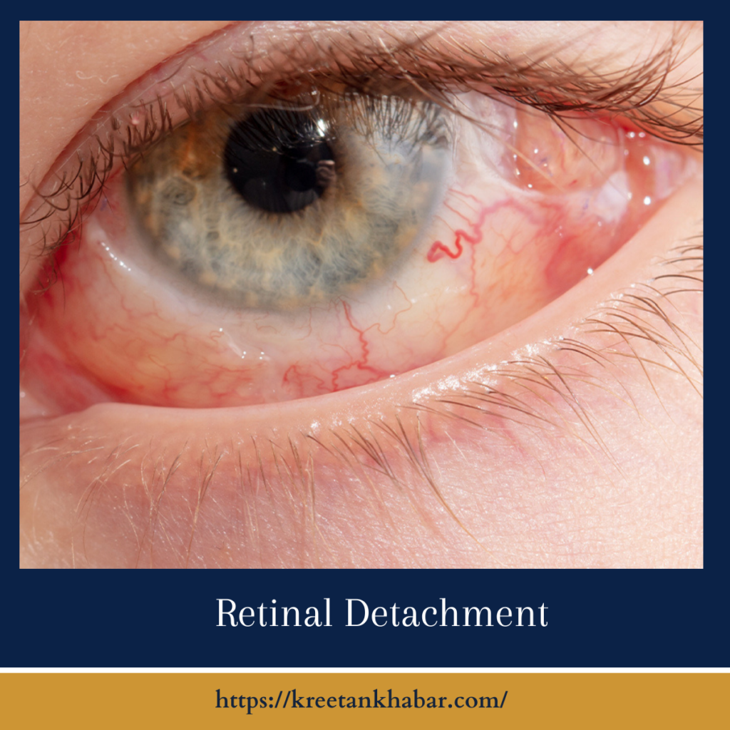 Retinal Detachment
