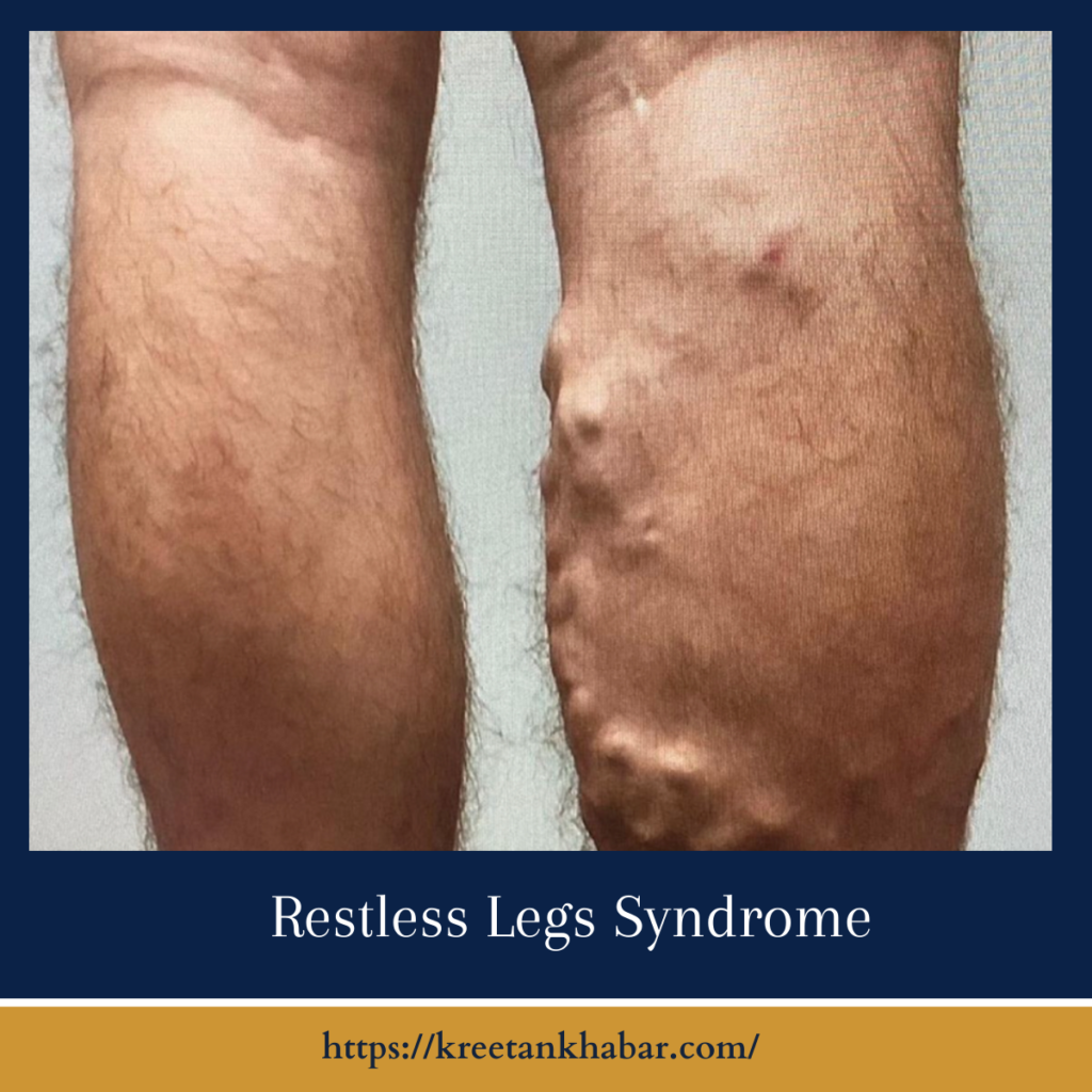 Restless Legs Syndrome