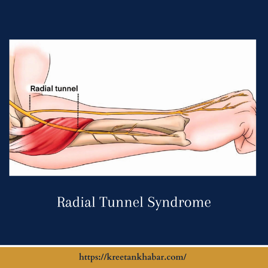 Radial Tunnel Syndrome