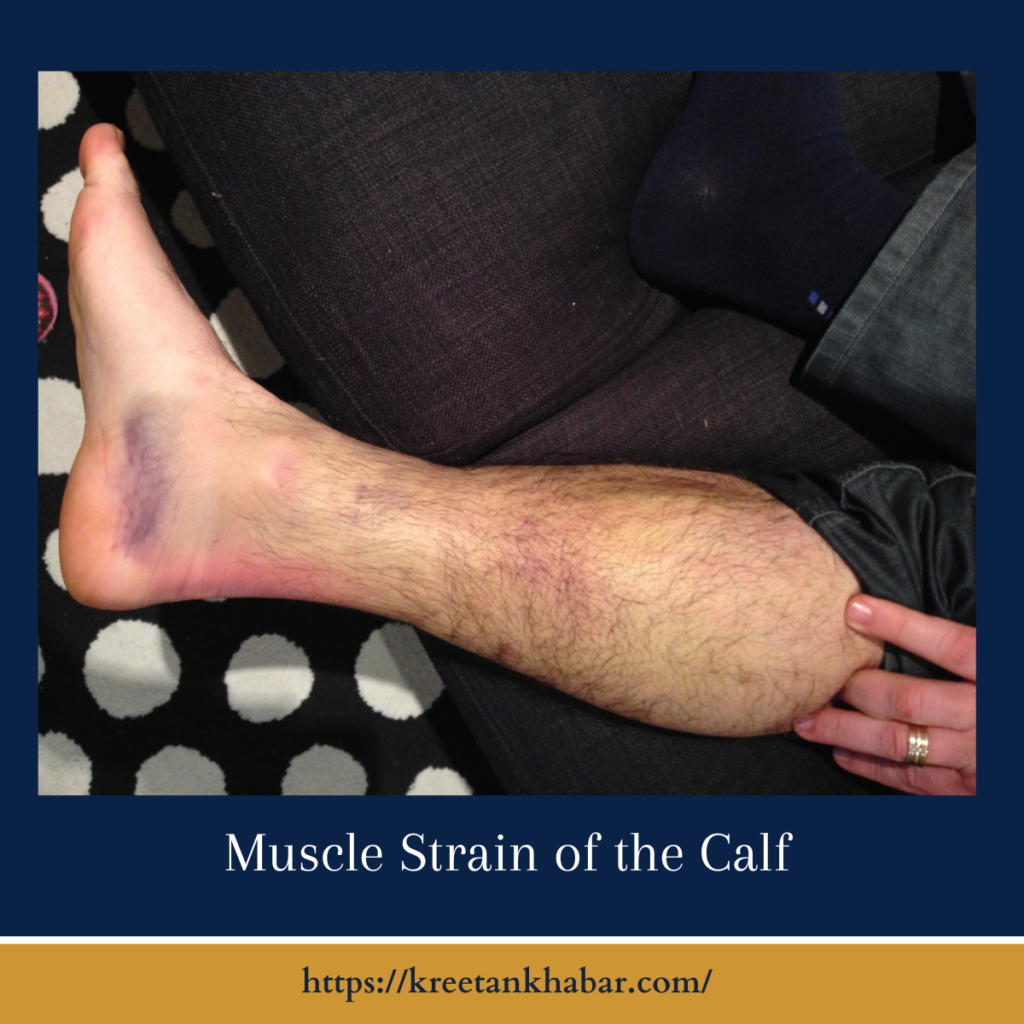 Muscle Strain of the Calf
