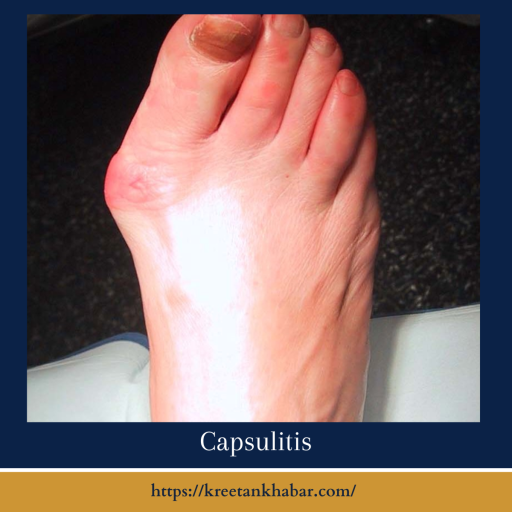 Capsulitis