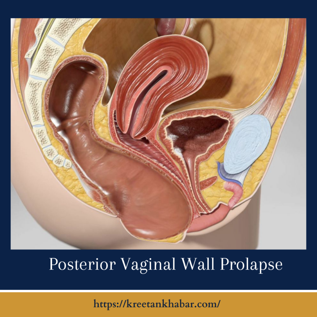 Posterior Vaginal Wall Prolapse