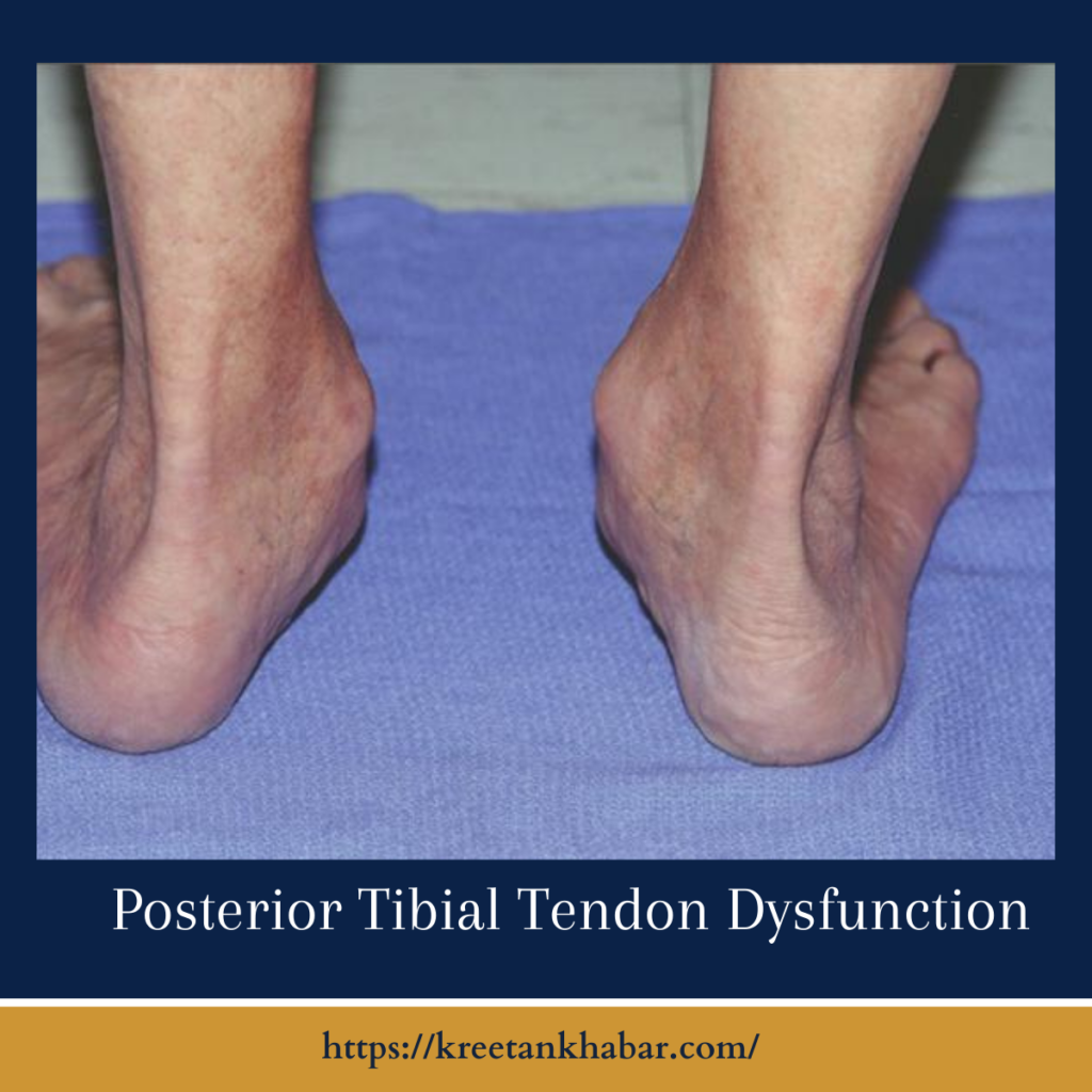 Posterior Tibial Tendon Dysfunction