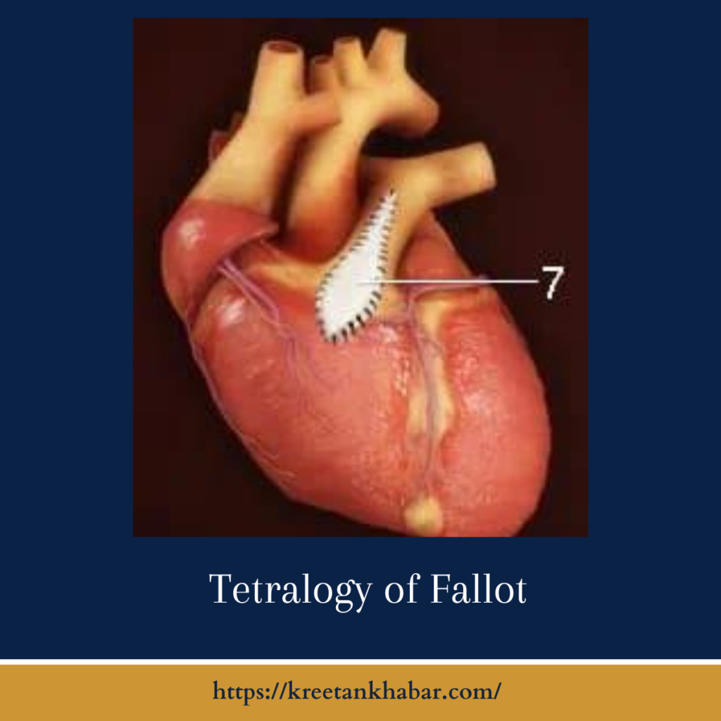 Tetralogy of Fallot