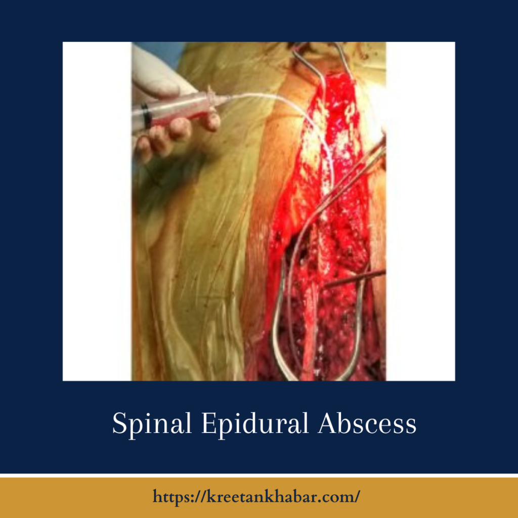 Spinal Epidural Abscess