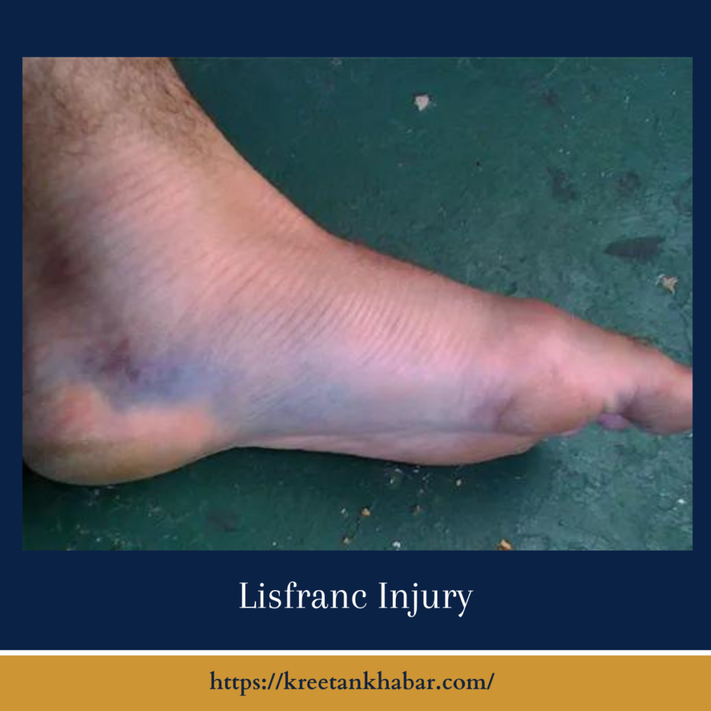 Lisfranc Injuries