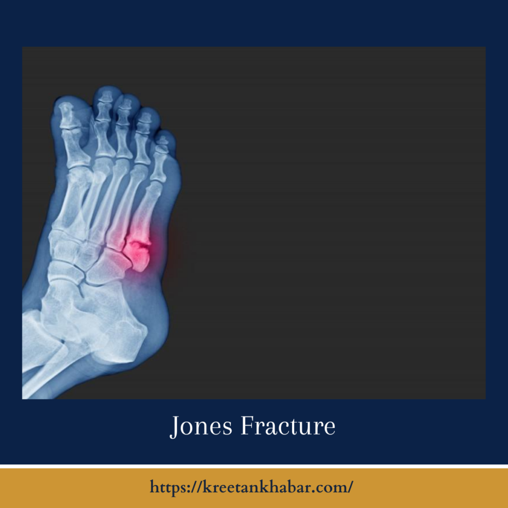 Jones Fracture