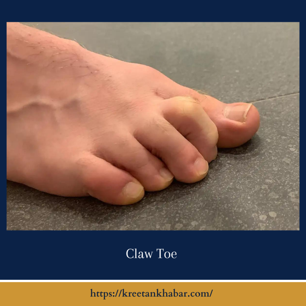 Claw Toe