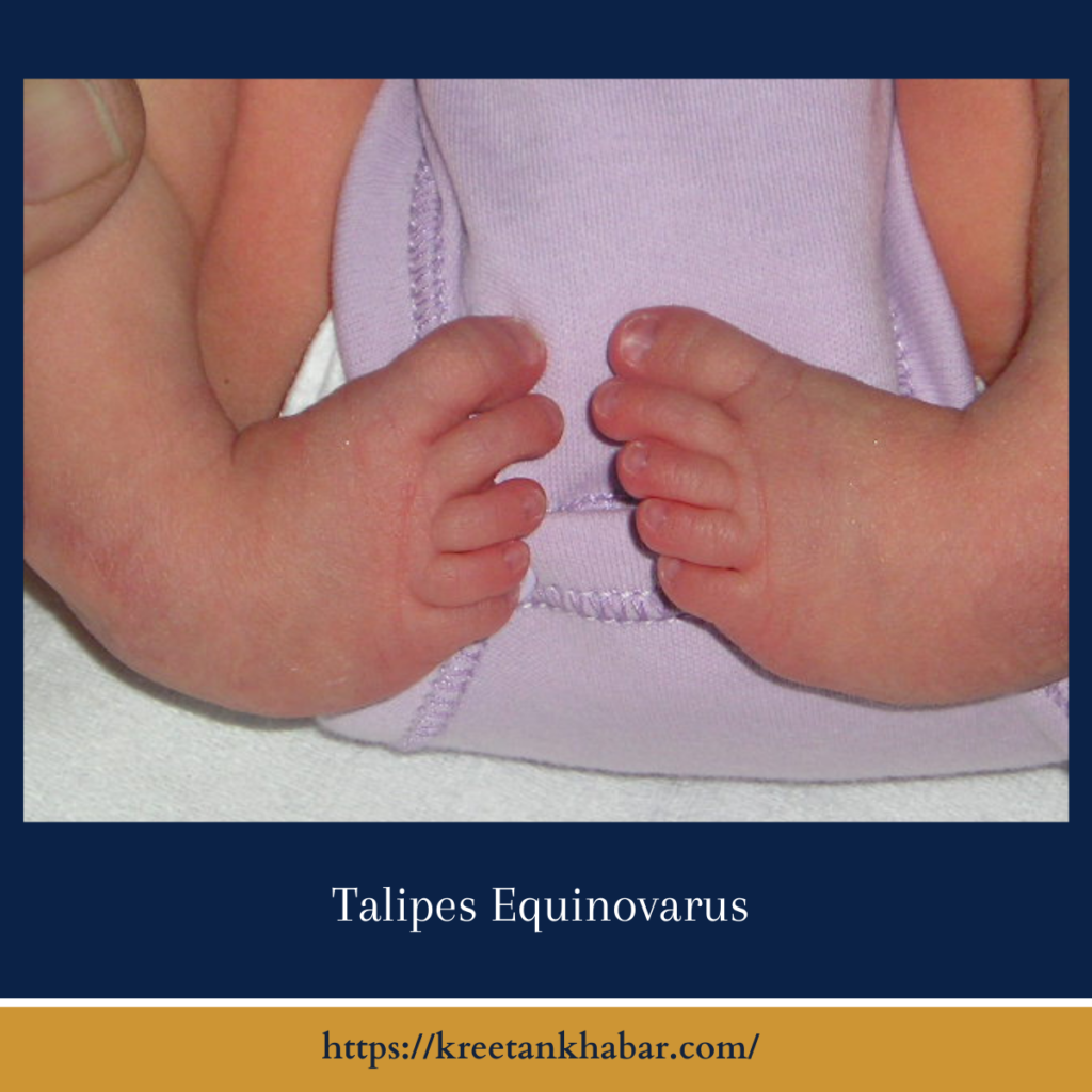 Talipes Equinovarus