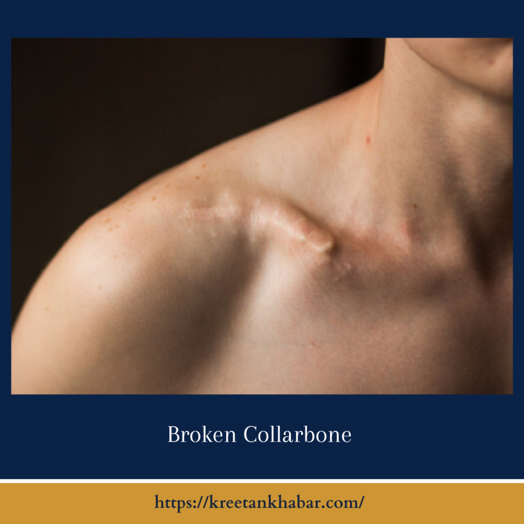 Broken Collarbone