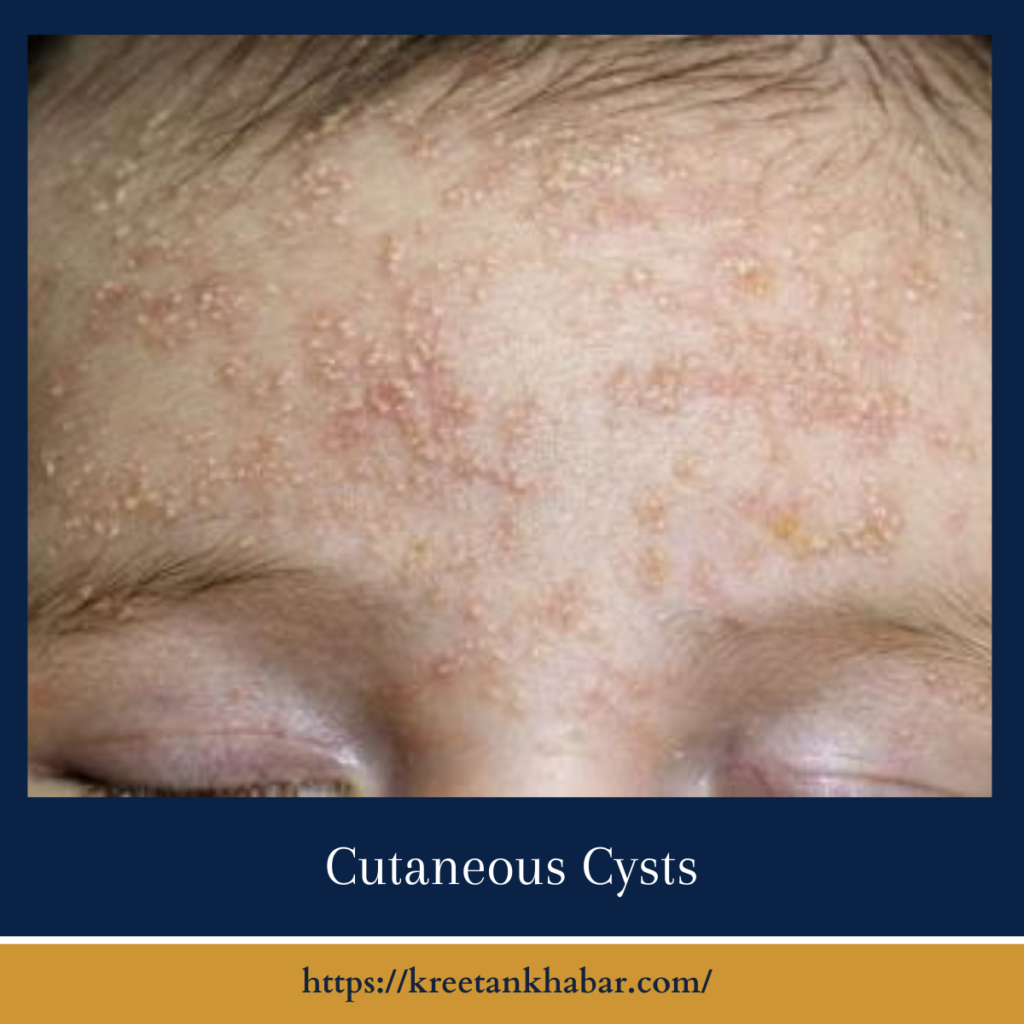 Cutaneous Cysts