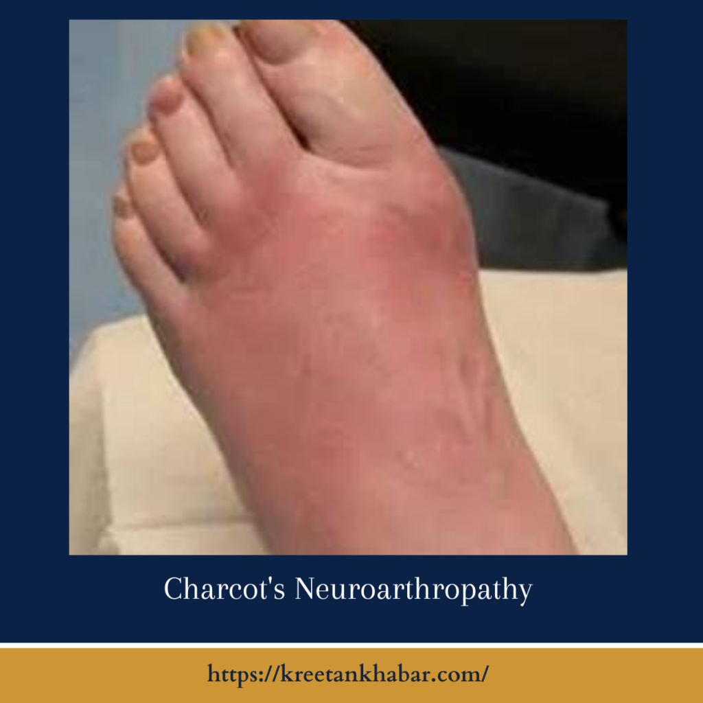 Charcots Neuroarthropathy