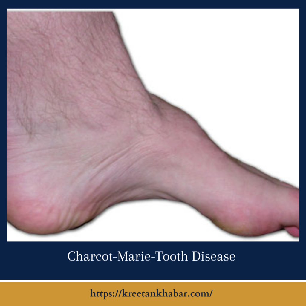 Charcot-Marie-Tooth Disease