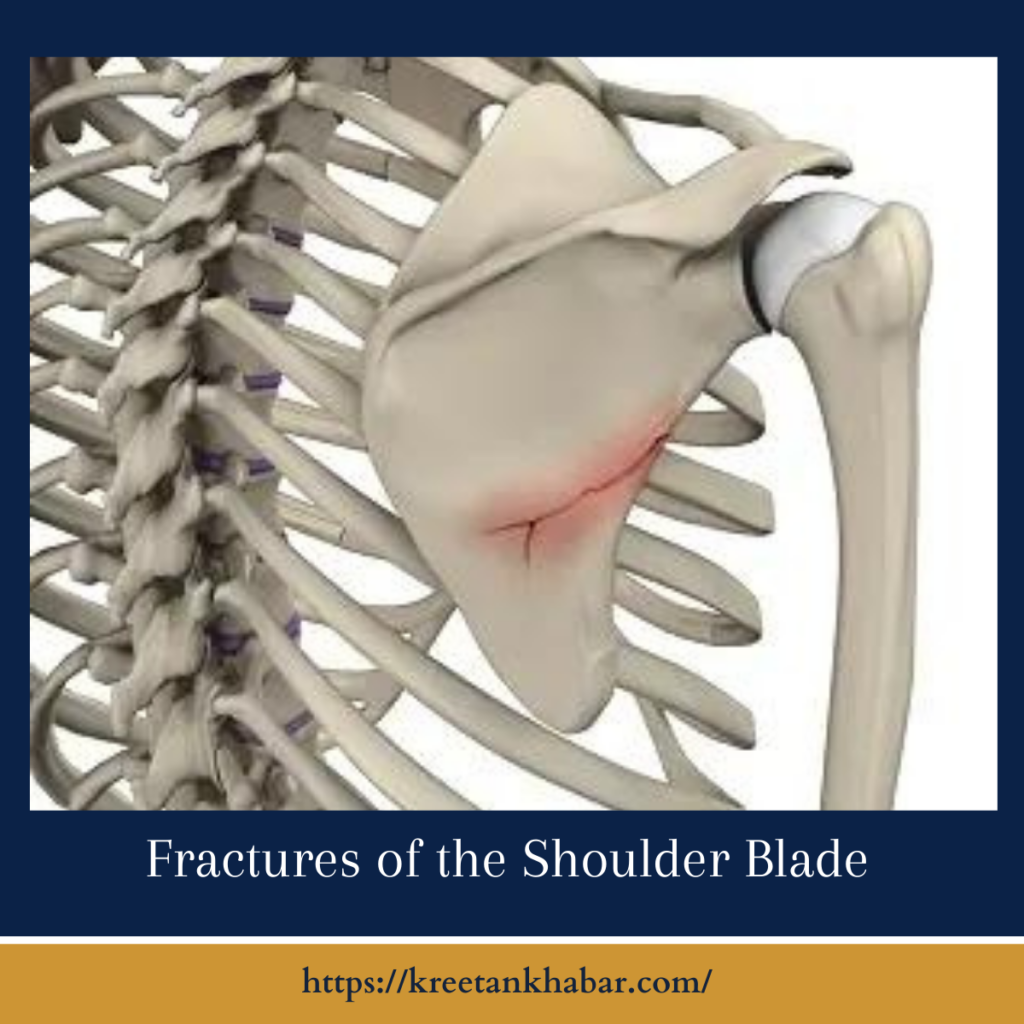 Fractures of the Shoulder Blade