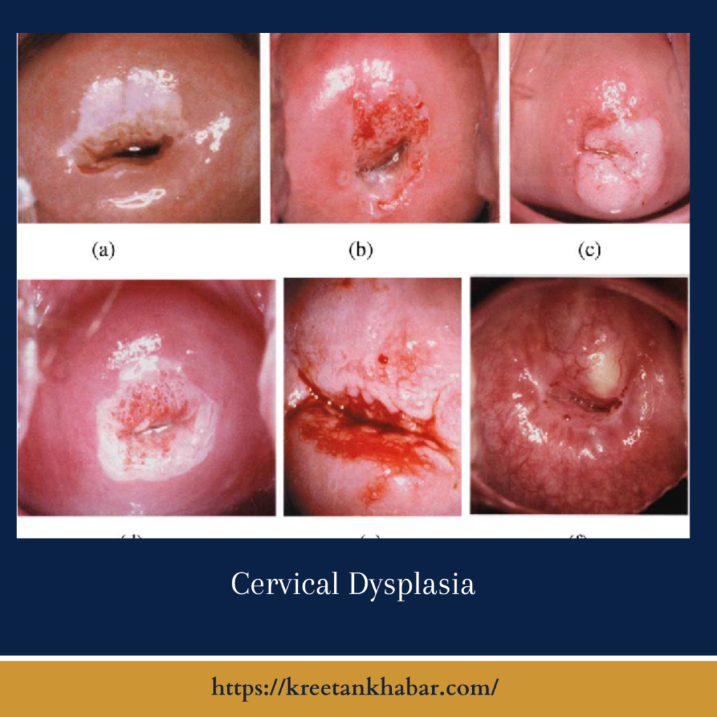 Cervical Dysplasia