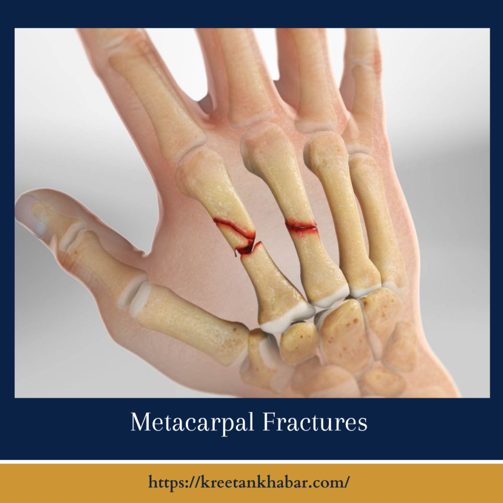 Metacarpal Fractures