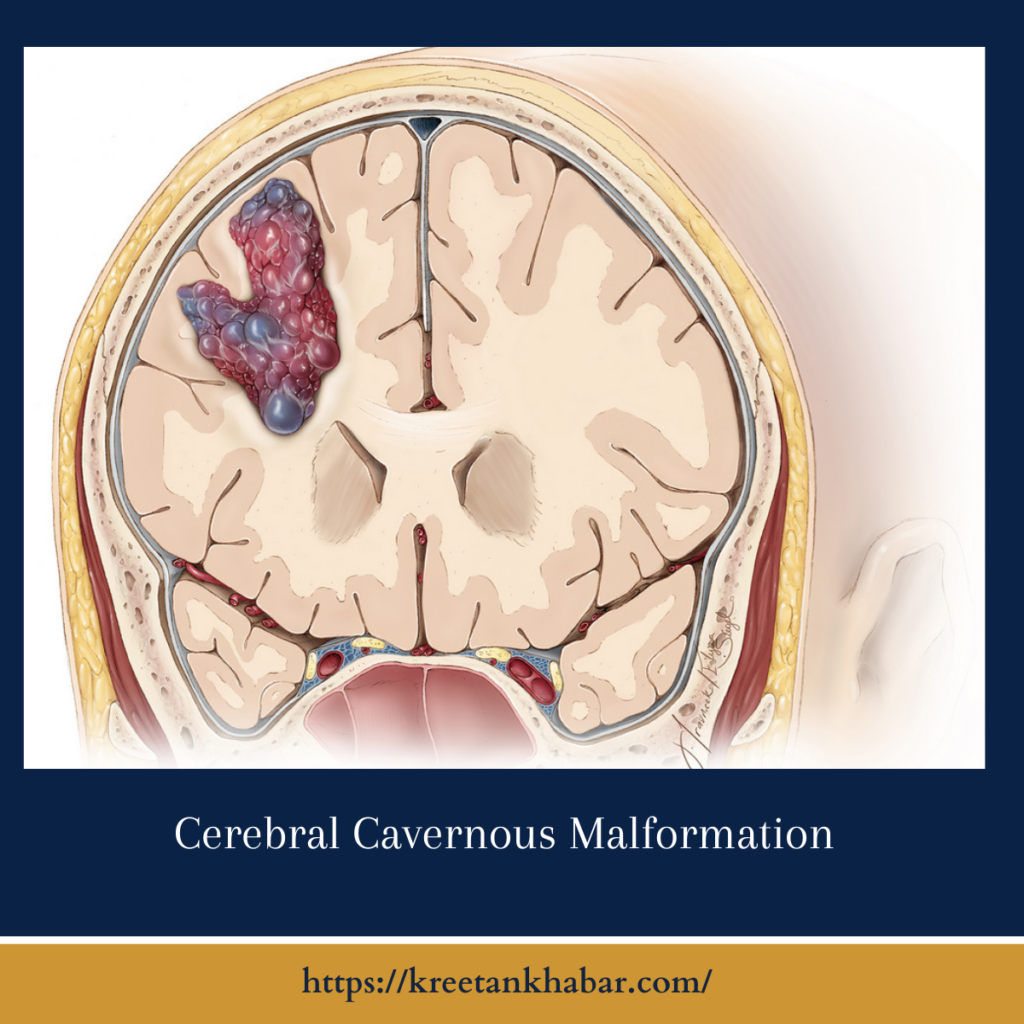 Cerebral Cavernous Malformation