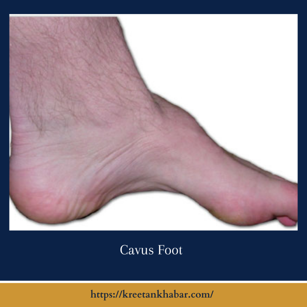 Cavus Foot