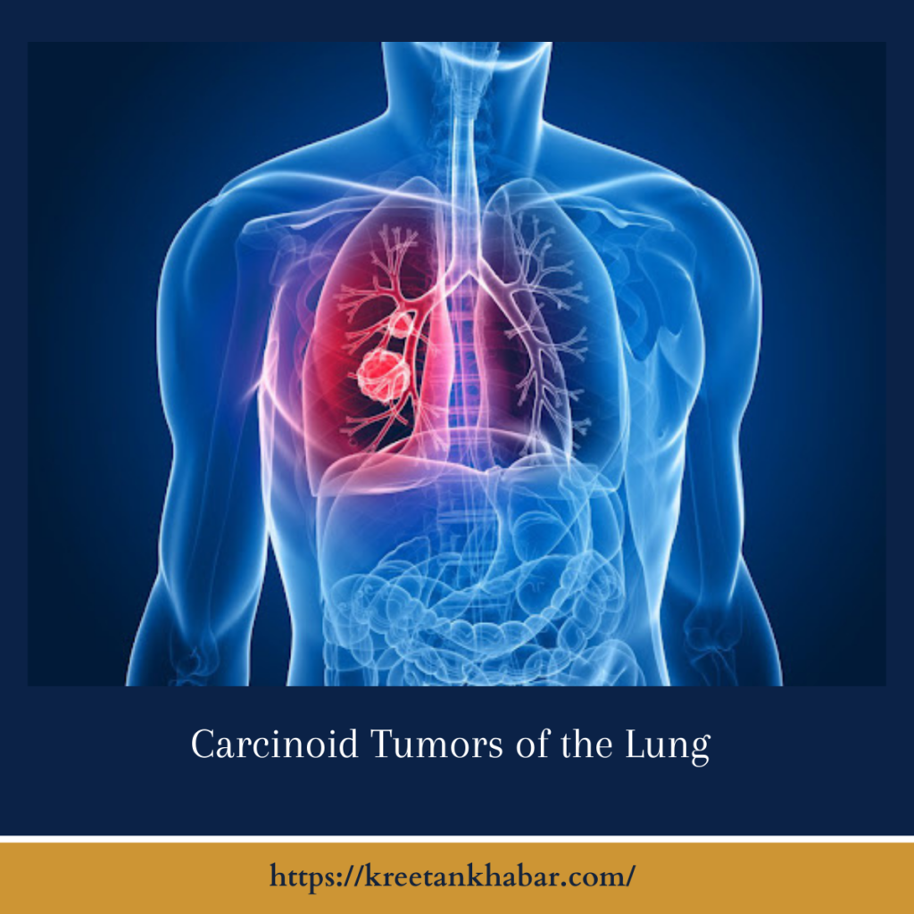 Carcinoid Tumors of the Lung