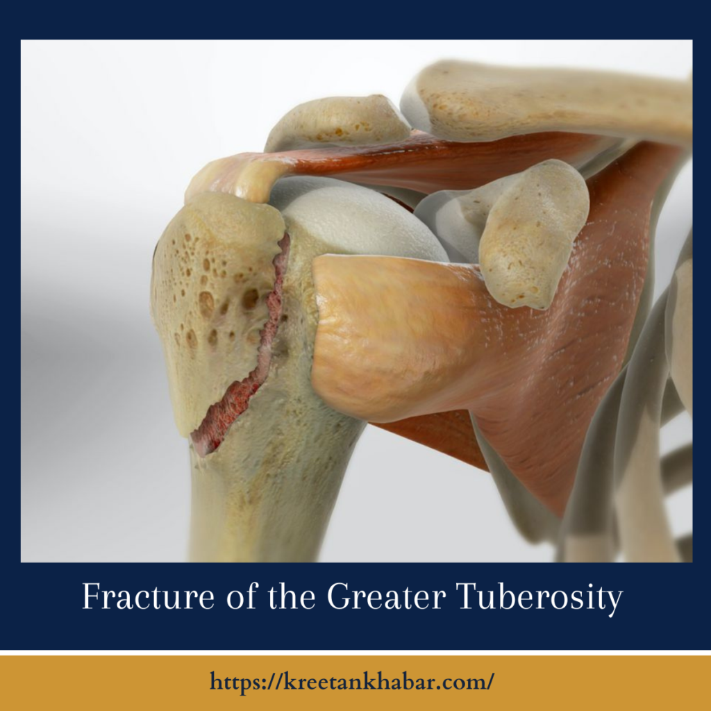 Fracture of the Greater Tuberosity