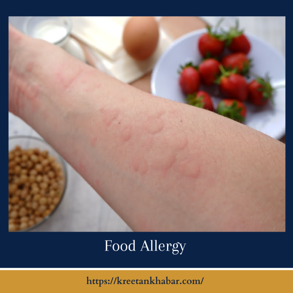 Food Allergies