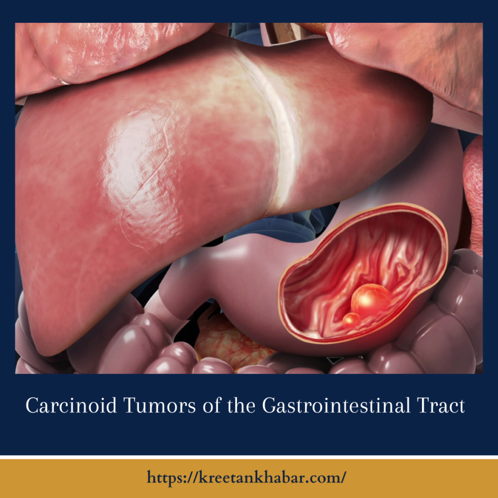 Carcinoid Tumors of the Gastrointestinal Tract