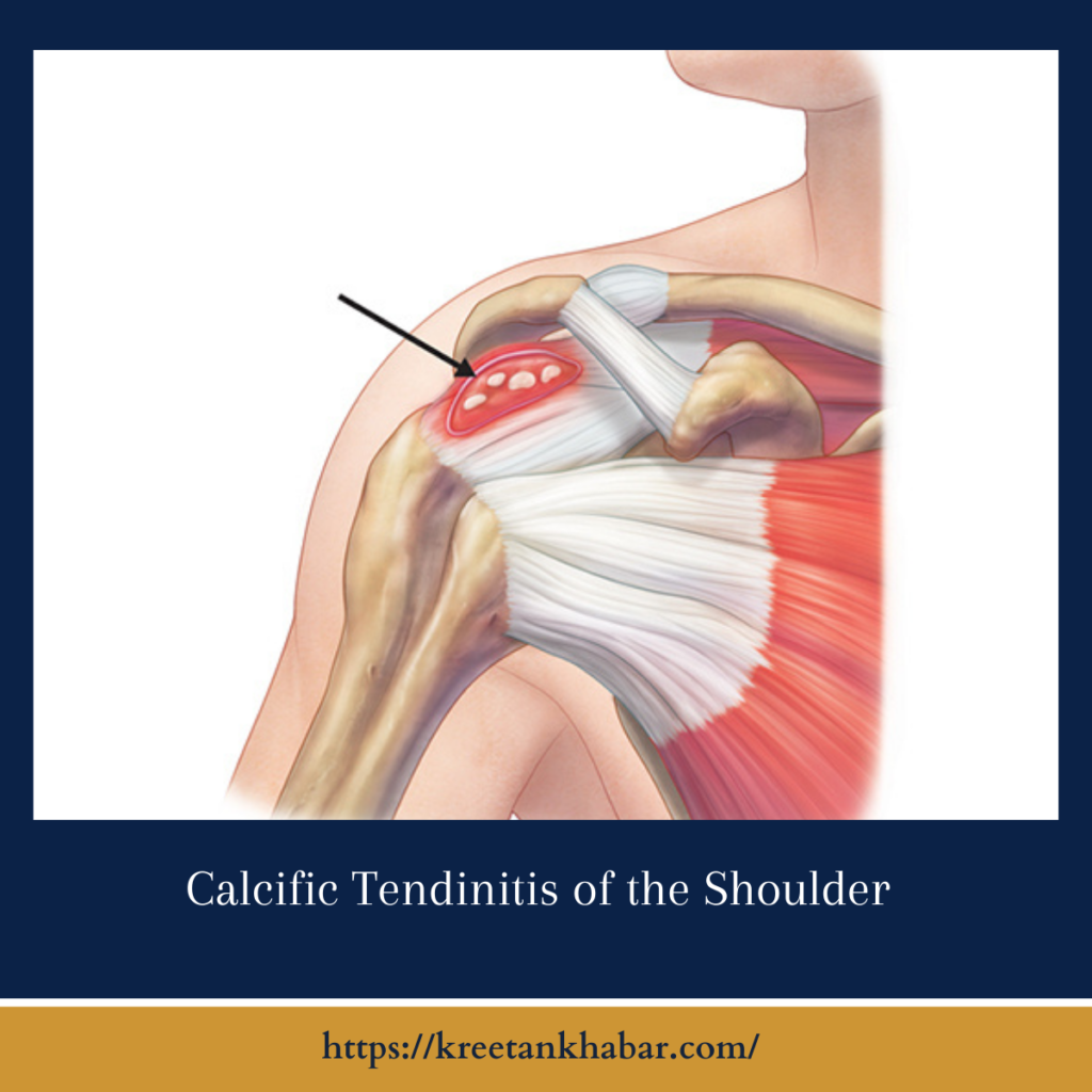 Calcific Tendinitis of the Shoulder