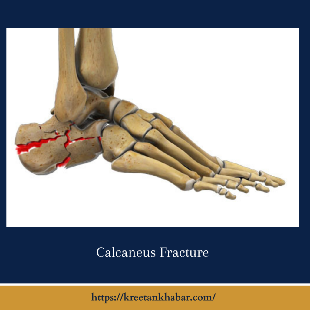 Calcaneus Fractures