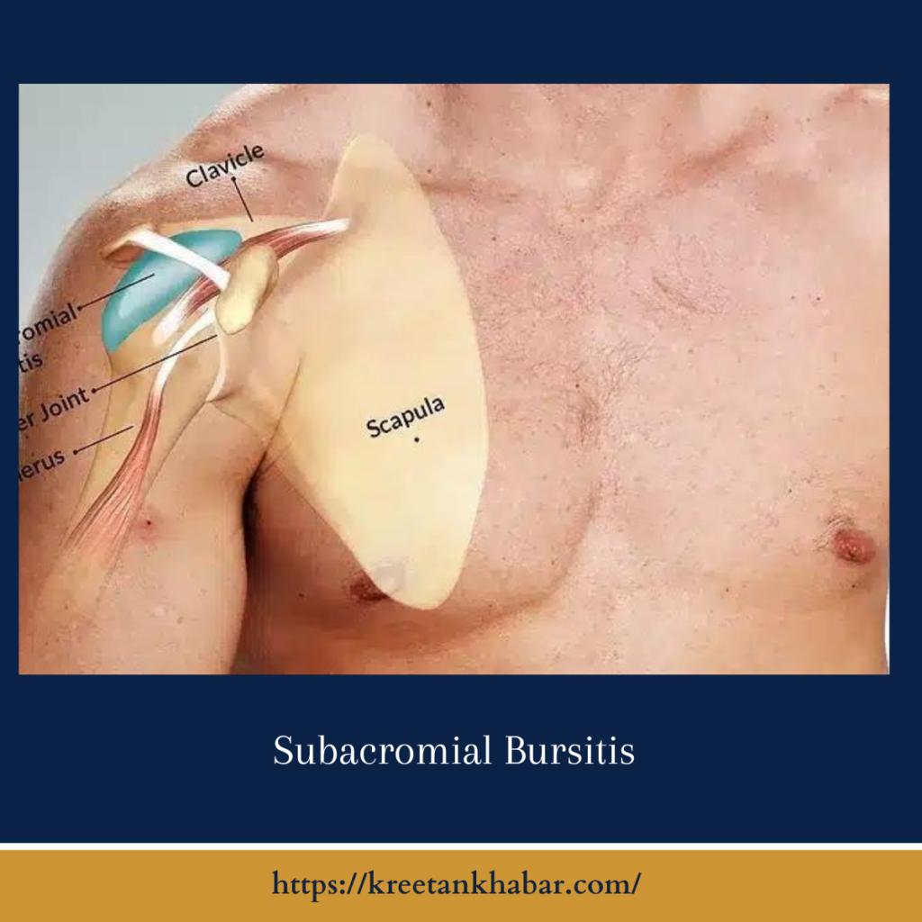 Subacromial Bursitis