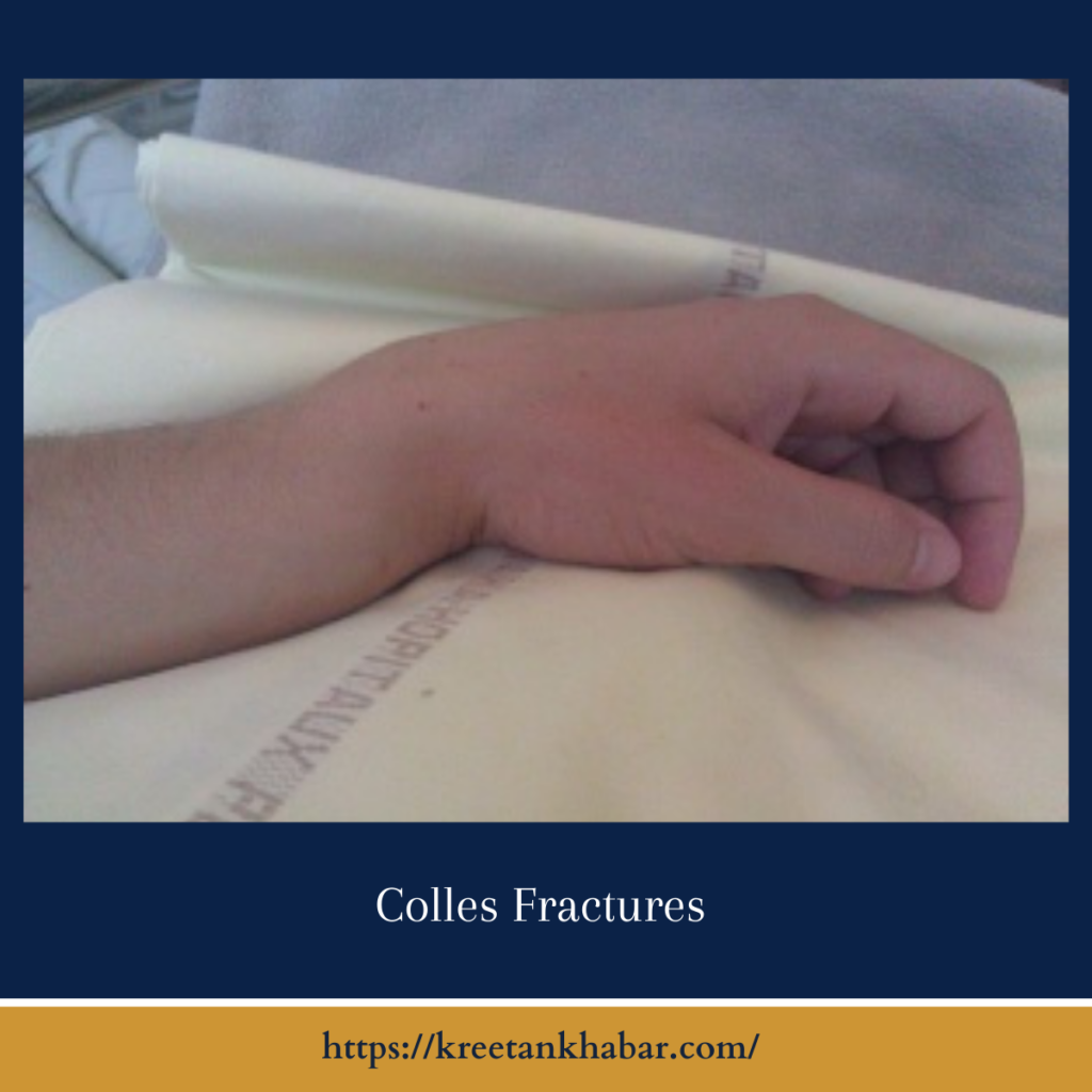 Colles Fractures