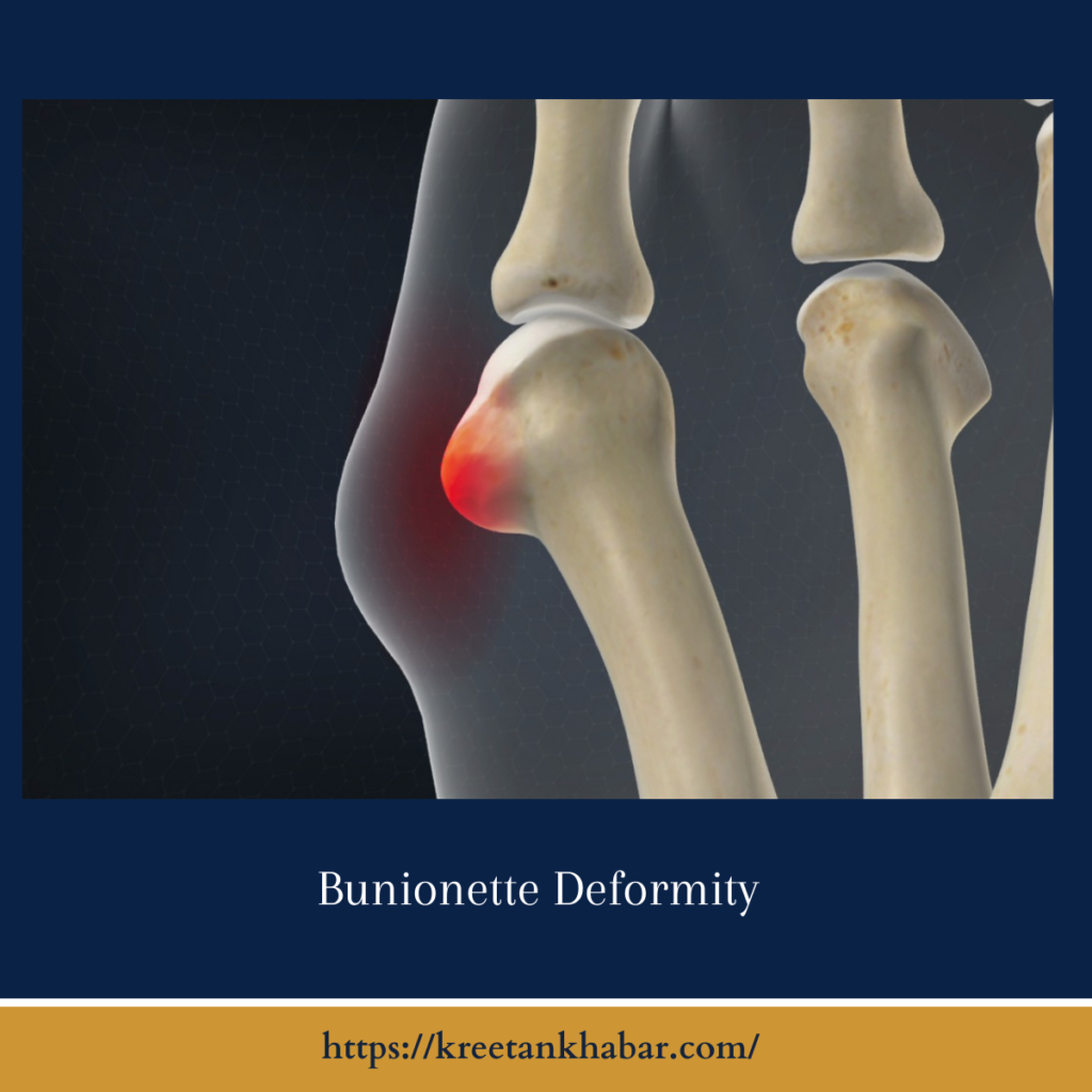 Bunionette Deformity