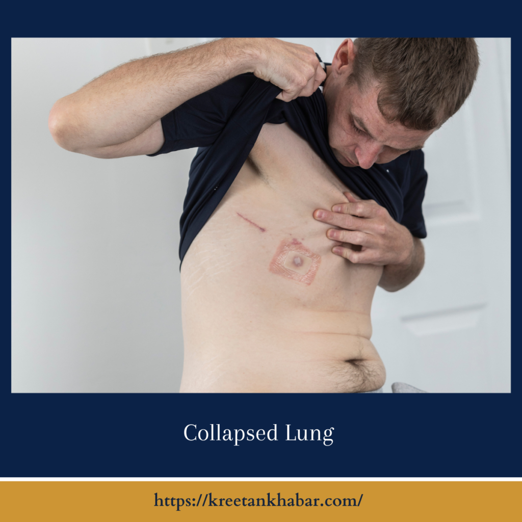 Collapsed Lung